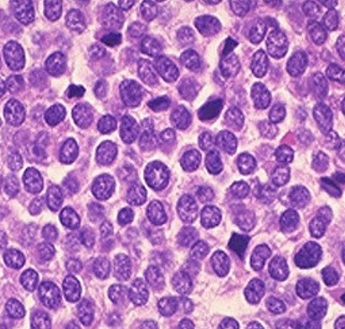 Ewing sarcoma small blue round cell sarcoma